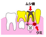 乳歯膿み